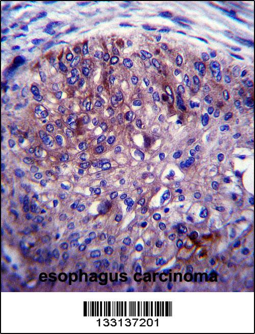 ADAL Antibody (C-term) (Cat. #AP13621b)immunohistochemistry analysis in formalin fixed and paraffin embedded human esophagus carcinoma followed by peroxidase conjugation of the secondary antibody and DAB staining.This data demonstrates the use of ADAL Antibody (C-term) for immunohistochemistry. Clinical relevance has not been evaluated.