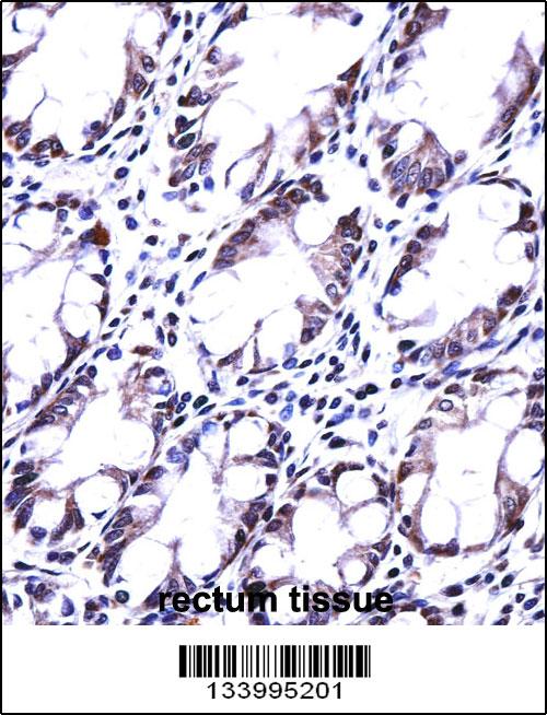 HRASLS5 Antibody (Center) (AP13881c)immunohistochemistry analysis in formalin fixed and paraffin embedded human rectum tissue followed by peroxidase conjugation of the secondary antibody and DAB staining.This data demonstrates the use of HRASLS5 Antibody (Center) for immunohistochemistry. Clinical relevance has not been evaluated.