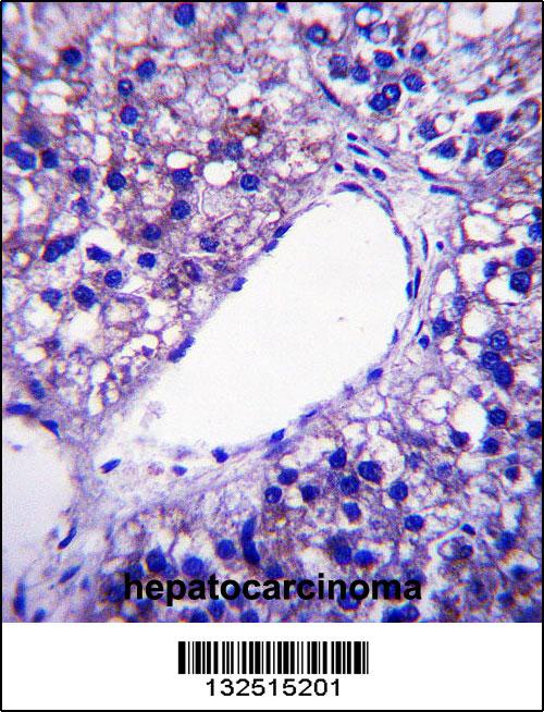 PNPLA4 Antibody (C-term) (Cat. #AP13971b)immunohistochemistry analysis in formalin fixed and paraffin embedded human hepatocarcinoma followed by peroxidase conjugation of the secondary antibody and DAB staining.This data demonstrates the use of PNPLA4 Antibody (C-term) for immunohistochemistry. Clinical relevance has not been evaluated.