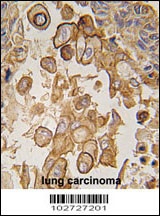 Formalin-fixed and paraffin-embedded human lung carcinoma tissue reacted with Mouse TLR6 antibody (C-term) (Cat.#AP1506c), which was peroxidase-conjugated to the secondary antibody, followed by DAB staining. This data demonstrates the use of this antibody for immunohistochemistry; clinical relevance has not been evaluated.