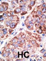 Formalin-fixed and paraffin-embedded human cancer tissue reacted with the primary antibody, which was peroxidase-conjugated to the secondary antibody, followed by AEC staining. This data demonstrates the use of this antibody for immunohistochemistry; clinical relevance has not been evaluated. BC = breast carcinoma; HC = hepatocarcinoma.