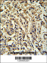 Sirt3 Antibody (C-term) (Cat. #AP6242b) IHC analysis in formalin fixed and paraffin embedded human breast carcinoma followed by peroxidase conjugation of the secondary antibody and DAB staining. This data demonstrates the use of the Sirt3 Antibody (C-term) for immunohistochemistry. Clinical relevance has not been evaluated.