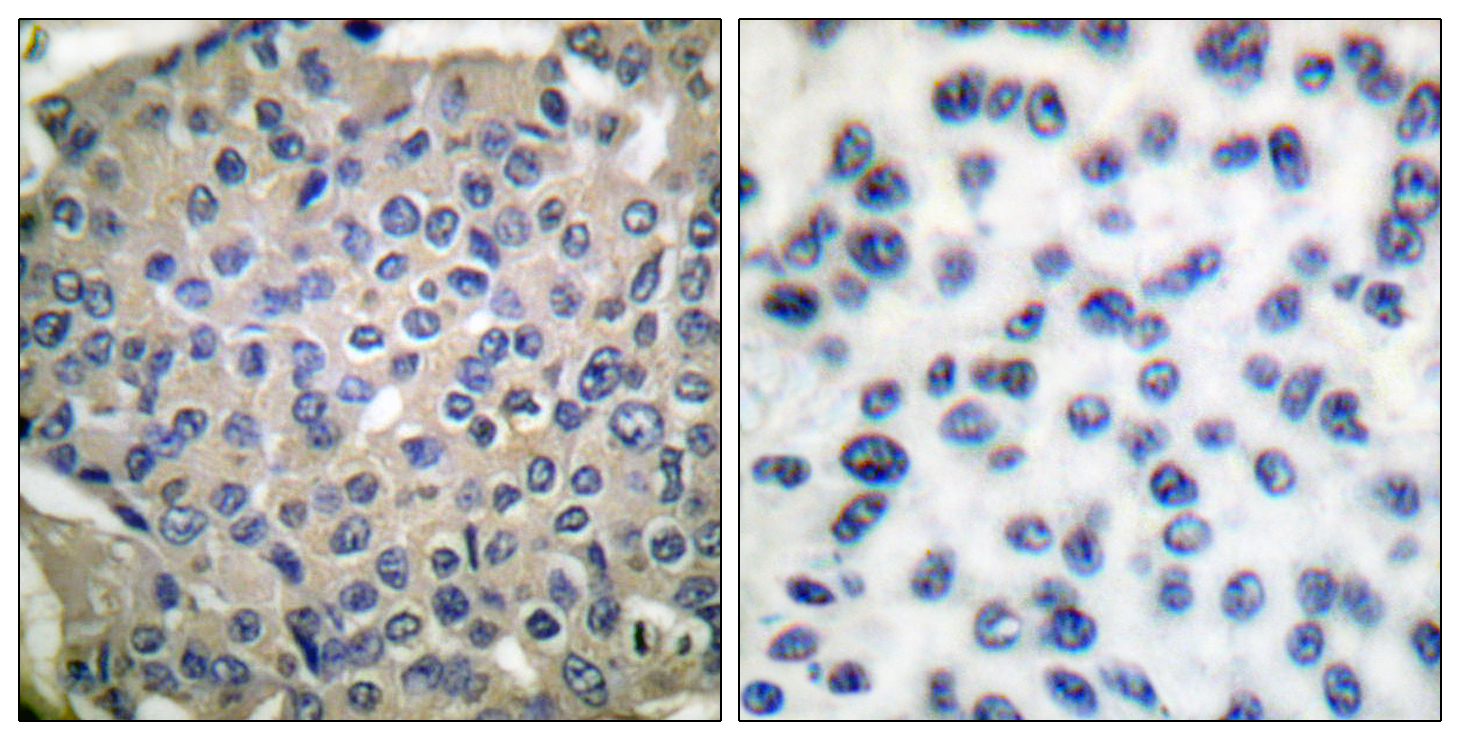 Immunohistochemical analysis of paraffin-embedded human breast carcinoma tissue, using Cortactin (phospho-Tyr466) antibody.