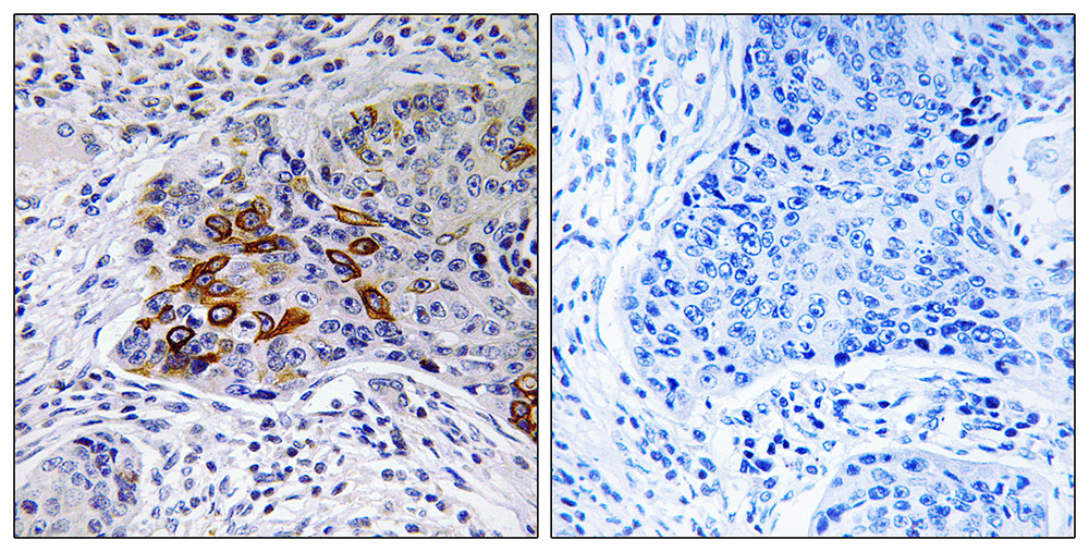 Immunohistochemistry analysis of paraffin-embedded human lung carcinoma tissue, using ADCY9 antibody.
