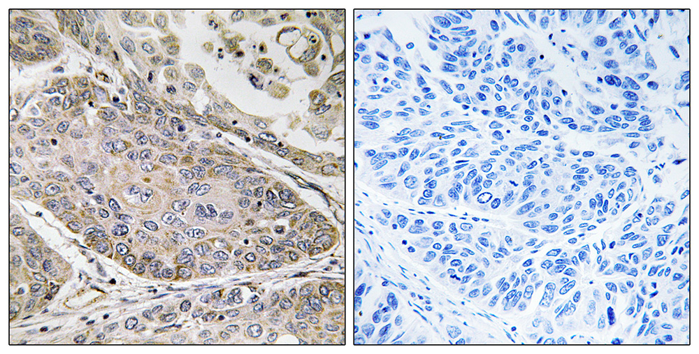 Immunohistochemistry analysis of paraffin-embedded human lung carcinoma tissue using PLA2G4E antibody.