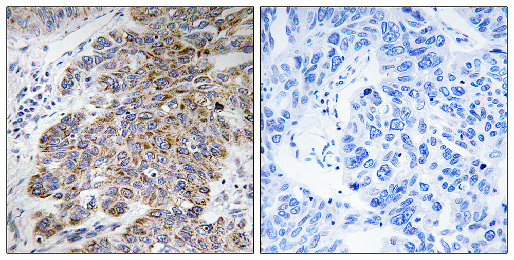 Immunohistochemistry analysis of paraffin-embedded human lung carcinoma tissue, using CHST10 antibody.