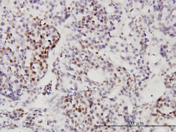Immunoperoxidase of monoclonal antibody to RNU3IP2 on formalin-fixed paraffin-embedded human ovary, clear cell carcinoma. [antibody concentration 3 ug/ml]