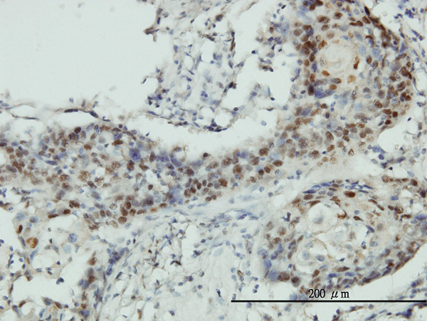 Immunoperoxidase of monoclonal antibody to RNMT on formalin-fixed paraffin-embedded human squamous cell carcinoma tissue. [antibody concentration 3 ug/ml]