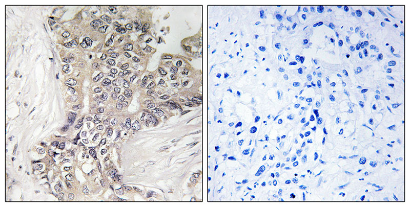 Immunohistochemistry analysis of paraffin-embedded human liver carcinoma tissue using B3GALTL antibody.