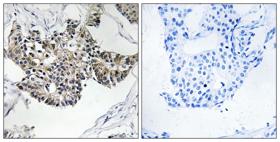 Immunohistochemistry analysis of paraffin-embedded human breast carcinoma tissue, using RSAD1 antibody.