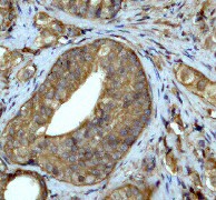 B. Immunohistochemical analysis of paraffin-embedded human prostate adenocarcinoma using anti-Ubiquitin (C-term) RabMAb (Cat. #AJ1807a).