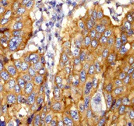 B. Immunohistochemical analysis of paraffin-embedded human lung carcinoma using anti-Synip RabMAb (Cat. #AJ1754a).
