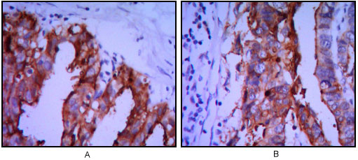 Figure 2: Immunohistochemical analysis of paraffin-embedded ovarian cancer (A), stomach cancer (B) using ALPP mouse mAb with DAB staining.