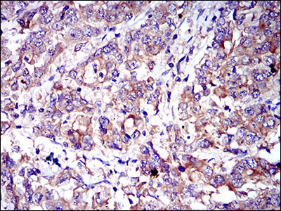 Figure 3: Immunohistochemical analysis of paraffin-embedded stomach cancer tissues using CD6 mouse mAb with DAB staining.