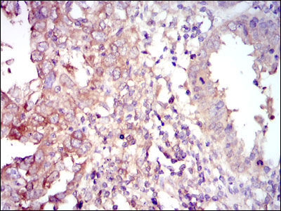Figure 4: Immunohistochemical analysis of paraffin-embedded intima cancer tissues using FOXO1 mouse mAb with DAB staining.