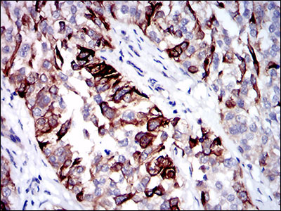 Figure 3: Immunohistochemical analysis of paraffin-embedded bladder cancer tissues using CK5 mouse mAb with DAB staining.