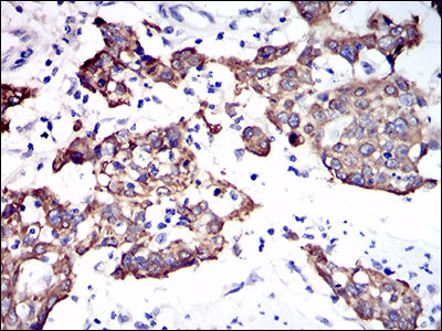 Figure 4: Immunohistochemical analysis of paraffin-embedded esophagus cancer tissues using CK5 mouse mAb with DAB staining.