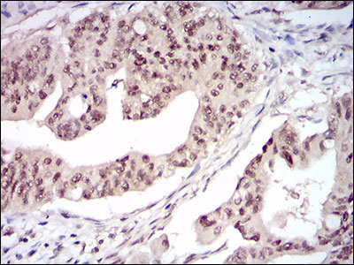 Figure 4: Immunohistochemical analysis of paraffin-embedded rectum cancer tissues using DNMT1 mouse mAb with DAB staining.