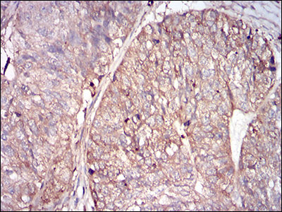 Figure 5: Immunohistochemical analysis of paraffin-embedded ovarian cancer tissues using FTL mouse mAb with DAB staining.