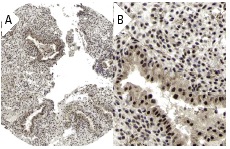 Dnmt2 (H-271): sc-20702. Immunoperoxidase staining of formalin fixed, paraffin-embedded human placenta tissue showing nuclear and cytoplasmic staining of decidual and trophoblastic cells at low (A) and high (B) magnification. Kindly provided by The Swedish Human Protein Atlas (HPA) program.