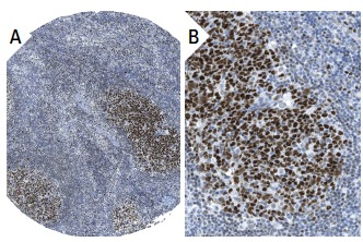 E2A (V-18): sc-349. Immunoperoxidase staining of formalin fixed, paraffin-embedded human lymph node tissue showing nuclear staining of reaction center cells at low (A) and high (B) magnification. Kindly provided by The Swedish Human Protein Atlas (HPA) program.