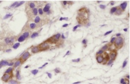 E2F-4 (RK-13): sc-511. Immunoperoxidase staining of formalin-fixed, paraffin-embedded human pancreas tumor.