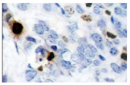 p-Histone cluster 1 H3E (Ser 10): sc-101697. Immunoperoxidase staining of formalin-fixed, paraffin-embedded human breast carcinoma tissue showing nuclear localization.