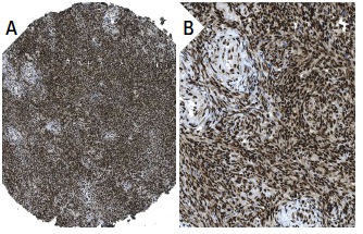 hnRNP K (F45 P9 C7): sc-53620. Immunoperoxidase staining of formalin fixed, paraffin-embedded human ovary tissue showing nuclear staining of follicle and stromal cells (low and high magnification). Kindly provided by The Swedish Human Protein Atlas (HPA) program.