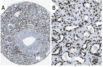 hnRNP L (4D11): sc-32317. Immunoperoxidase staining of formalin fixed, paraffin-embedded human kidney tissue showing nuclear staining of cells in glomeruli and tubules (low and high magnification). Kindly provided by The Swedish Human Protein Atlas (HPA) program.