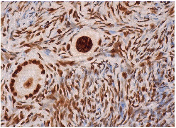 hnRNP L (4D11): sc-32317. Immunoperoxidase staining of formalin fixed, paraffin-embedded human ovary tissue showing nuclear staining of follicle cells and ovarian stroma cells.