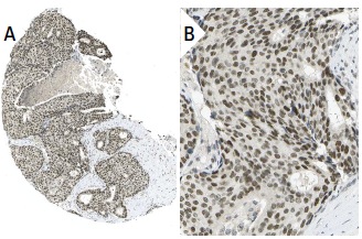HP1 (FL-191): sc-28735. Immunoperoxidase staining of formalin fixed, paraffin-embedded human breast cancer tissue showing nuclear staining of tumor cells (low and high magnification). Kindly provided by The Swedish Human Protein Atlas (HPA) program.