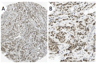 hSNF2H (H-300): sc-13054. Immunoperoxidase staining of formalin fixed, paraffin-embedded human breast cancer tissue showing nuclear staining of tumor cells at low (A) and high (B) magnification. Kindly provided by The Swedish Human Protein Atlas (HPA) program.