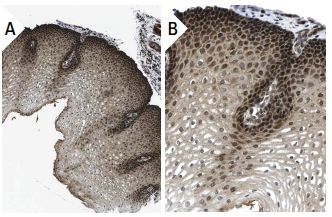 KIN17 (K36): sc-32768. Immunoperoxidase staining of formalin fixed, paraffin-embedded human esophagus tissue showing nuclear and cytoplasmic staining of squamous epithelial cells at low (A) and high (B) magnification. Kindly provided by The Swedish Human Protein Atlas (HPA) program.