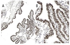 mSin3A (G-11): sc-5299. Immunoperoxidase staining of formalin fixed, paraffin-embedded human fallopian tube tissue showing nuclear staining of glandular cells at low (A) and high (B) magnification. Kindly provided by The Swedish Human Protein Atlas (HPA) program.