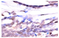 MTA2 (C-20): sc-9447. Immunoperoxidase staining of formalin-fixed, paraffin-embedded human breast tumor showing nuclear staining.