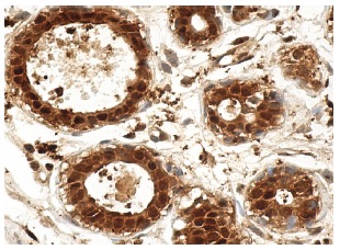 DJ-1 (D-4): sc-55572. Immunoperoxidase staining of formalin fixed, paraffin-embedded human breast tissue showing nuclear and cytoplasmic staining of glandular cells.