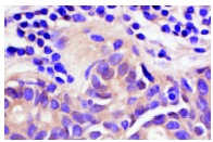 NFκB p50 (NLS): sc-114. Immunoperoxidase staining of formalin-fixed, paraffin-embedded human breast tumor showing nuclear and cytoplasmic staining.