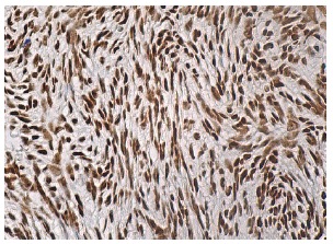 NF45 (H-4): sc-365283. Immunoperoxidase staining of formalin fixed, paraffin-embedded human ovary tissue showing nuclear staining of ovarian stroma cells.