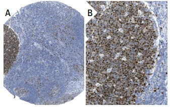 ORC6 (3A4): sc-32735. Immunoperoxidase staining of formalin fixed, paraffin-embedded human tonsil tissue showing nuclear staining of lymphoid cells (low and high magnification). Kindly provided by The Swedish Human Protein Atlas (HPA) program.