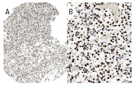PML (H-238): sc-5621. Immunoperoxidase staining of formalin fixed, paraffin-embedded human renal cancer tissue showing nuclear staining of tumor cells at low (A) and high (B) magnification. Kindly provided by The Swedish Human Protein Atlas (HPA) program.