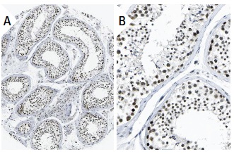 PRP8 (E-5): sc-55533. Immunoperoxidase staining of formalin fixed, paraffin-embedded human testis tissue showing nuclear staining of cells in seminiferus ducts and Leidig cells (low and high magnification). Kindly provided by The Swedish Human Protein Atlas (HPA) program.