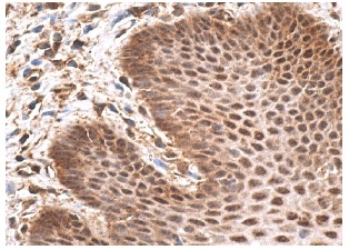 Smad1/2/3 (H-2): sc-7960. Immunoperoxidase staining of formalin fixed, paraffin-embedded human esophagus tissue showing nuclear and cytoplasmic staining of squamous epithelial cells.