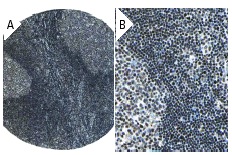 SRF (G-20): sc-335. Immunoperoxidase staining of formalin fixed, paraffin-embedded human lymph node tissue showing nuclear staining of follicle and non follicle cells at low (A) and high (B) magnification. Kindly provided by The Swedish Human Protein Atlas (HPA) program.