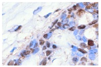 TAF II p32 (N-16): sc-1247. Immunoperoxidase staining of formalin-fixed, paraffin-embedded human breast showing nuclear staining of selected cells.