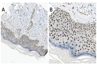 TAF II p32 (N-16): sc-1247. Immunoperoxidase staining of formalin fixed, paraffin-embedded human skin tissue showing nuclear staining of adnexal and epidermal cells (low and high magnification). Kindly provided by The Swedish Human Protein Atlas (HPA) program.