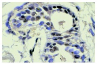 TAF II p250 (6B3): sc-735. Immunoperoxidase staining of formalin-fixed, paraffin-embedded human breast tumor showing nuclear staining.