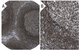TAF II p250 (6B3): sc-735. Immunoperoxidase staining of formalin fixed, paraffin-embedded human tonsil tissue showing nuclear staining of lymphoid cells and squamous epithelial cells at low (A) and high (B) magnification. Kindly provided by The Swedish Human Protein Atlas (HPA) program.