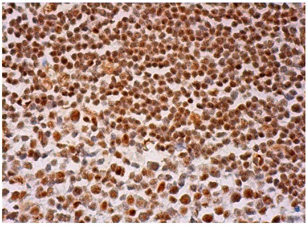 TFII-I (H-58): sc-28716. Immunoperoxidase staining of formalin fixed, paraffin-embedded human lymph node tissue showing nuclear staining of cells in germinal centers and cells in non-germinal centers.