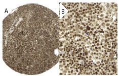 TFIIE β (C-21): sc-238. Immunoperoxidase staining of formalin fixed, paraffin-embedded human urothelial cancer tissue showing nuclear and cytoplasmic staining of tumor cells at low (A) and high (B) magnification. Kindly provided by The Swedish Human Protein Atlas (HPA) program.
