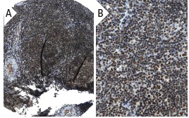 TRAP150 (H-300): sc-48779. Immunoperoxidase staining of formalin fixed, paraffin-embedded human tonsil tissue showing nuclear staining of lymphoid cells and squamous epithelial cells (low and high magnification). Kindly provided by The Swedish Human Protein Atlas (HPA) program.